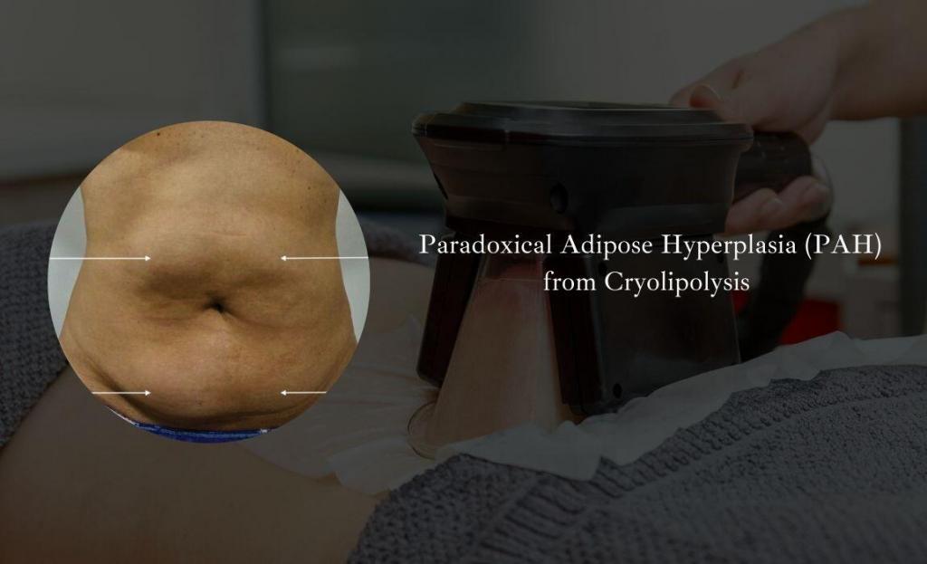 PAH after cryolipolysis