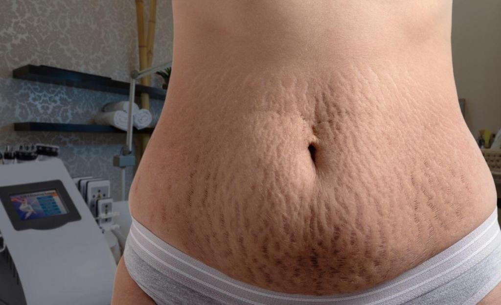 close up of woman's stretch marks with 6 in 1 body contouring device in the background