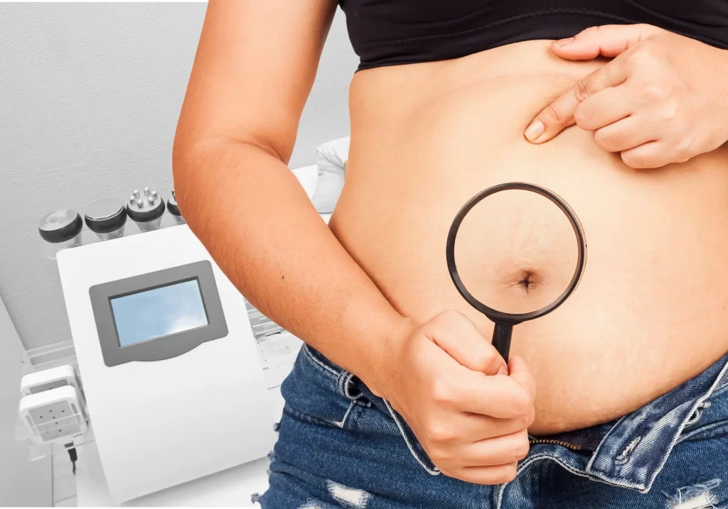 6 in 1 lipo laser for stretch marks